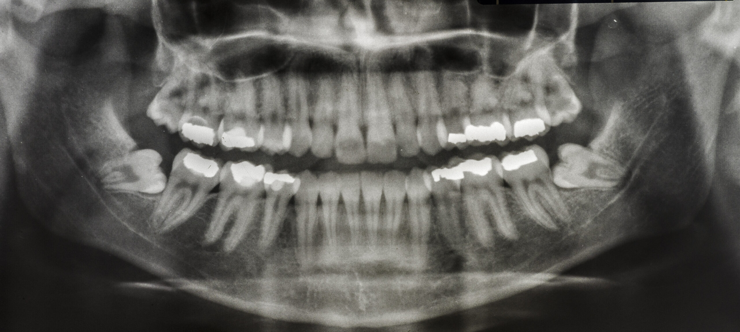 Xray of teeth